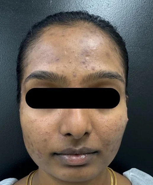 Before treatment 1