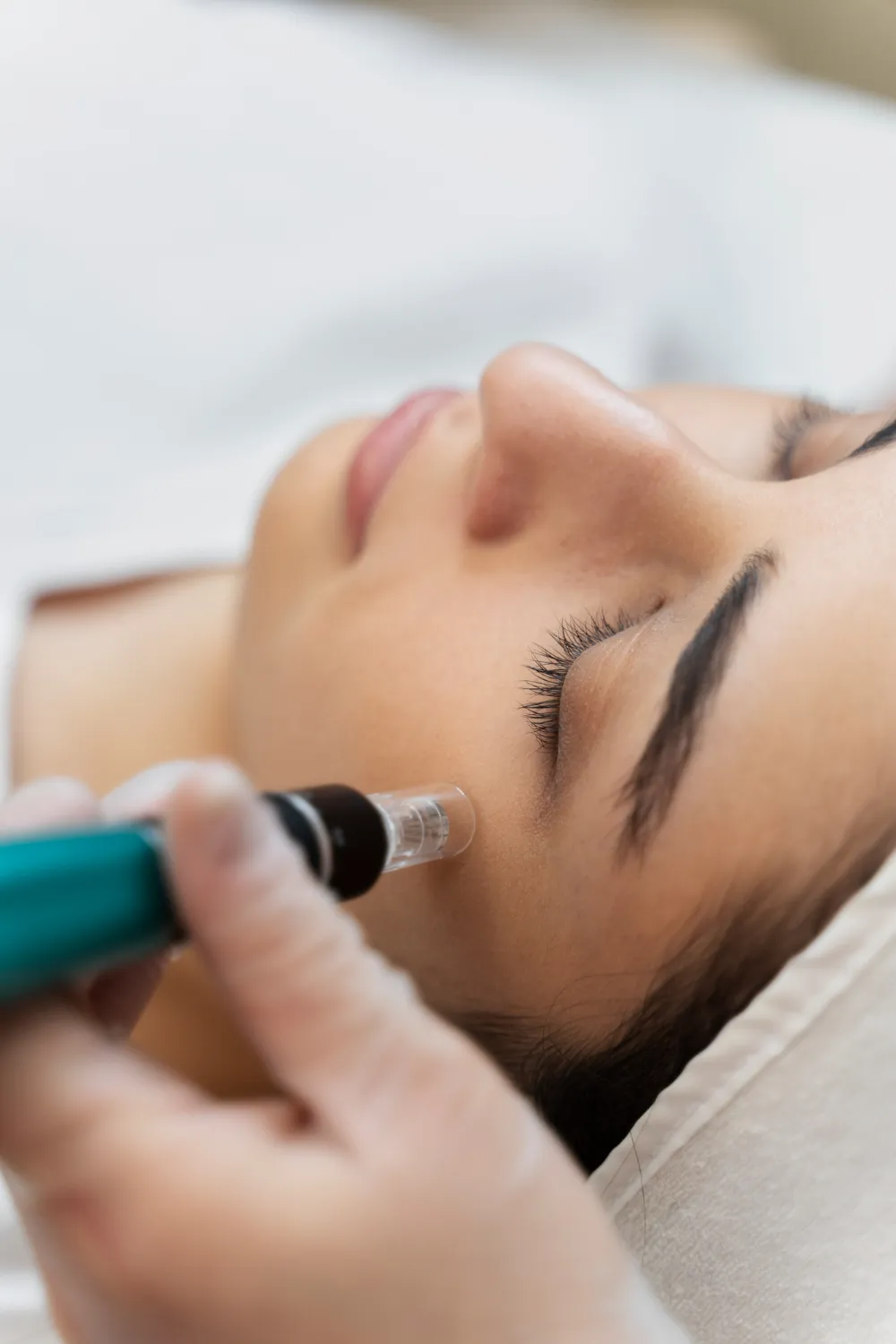 RF Microneedling for Skin Tightening