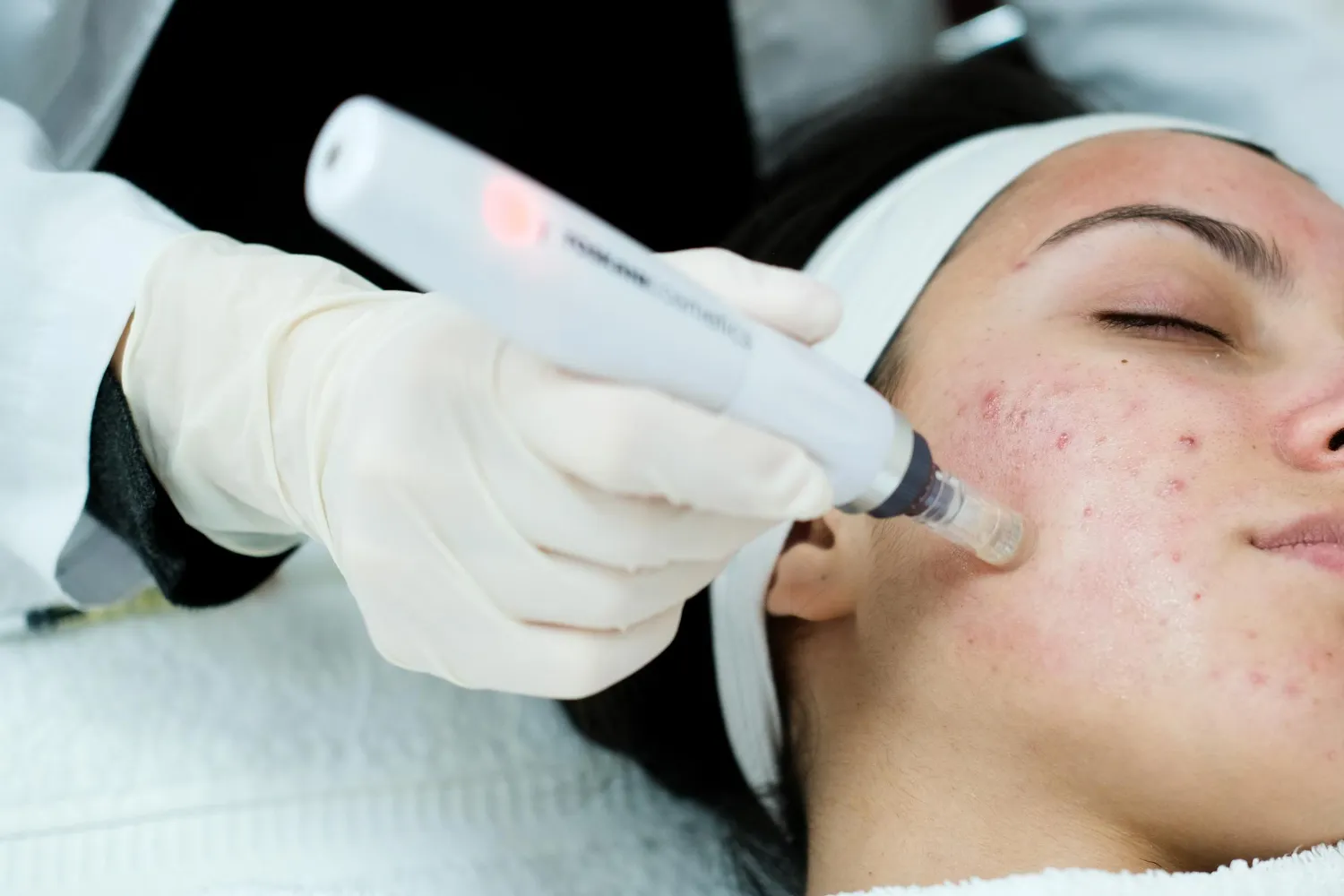 Fractional Laser for Acne Scars