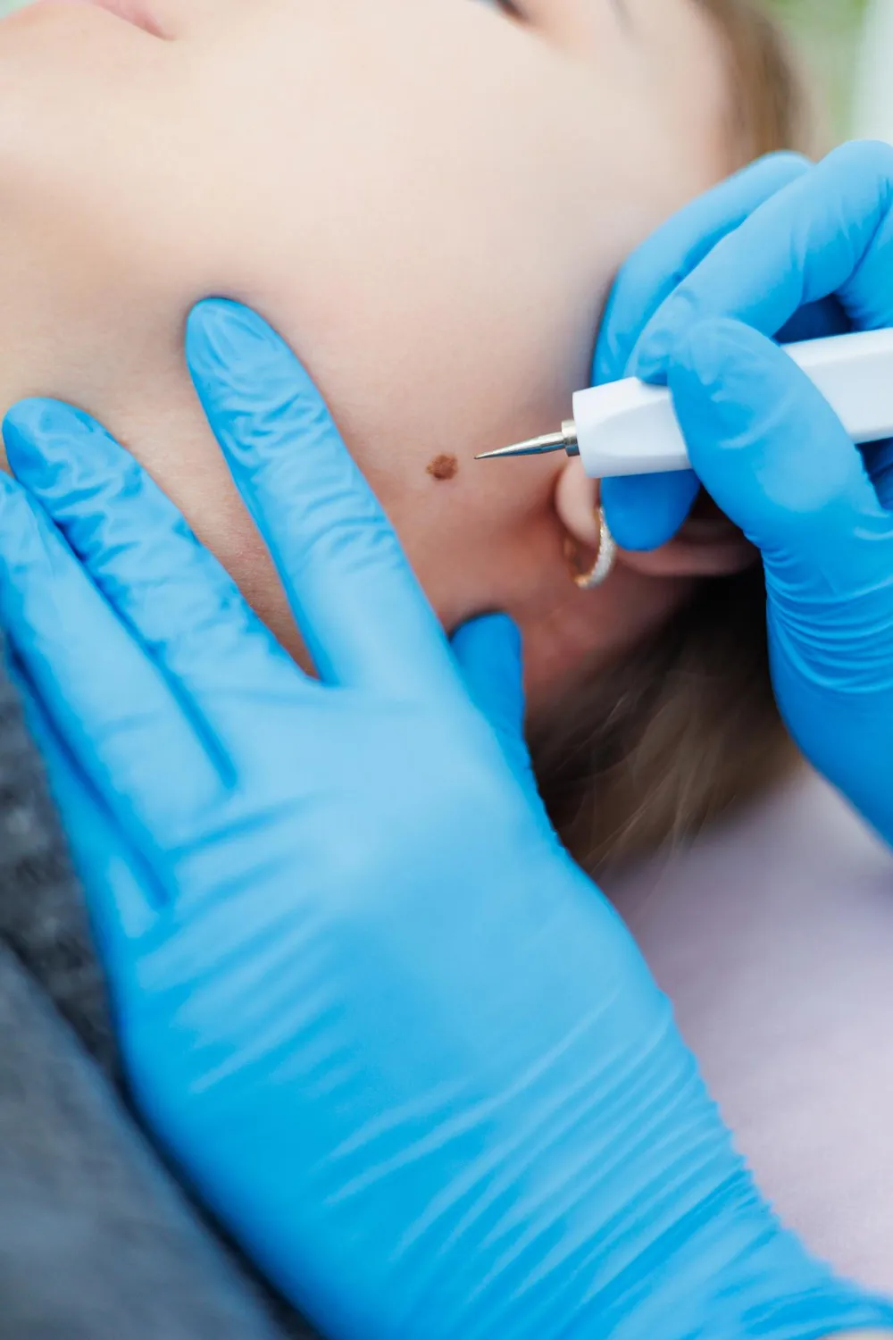 Wart, Mole, Skin Tag & Cyst Removal