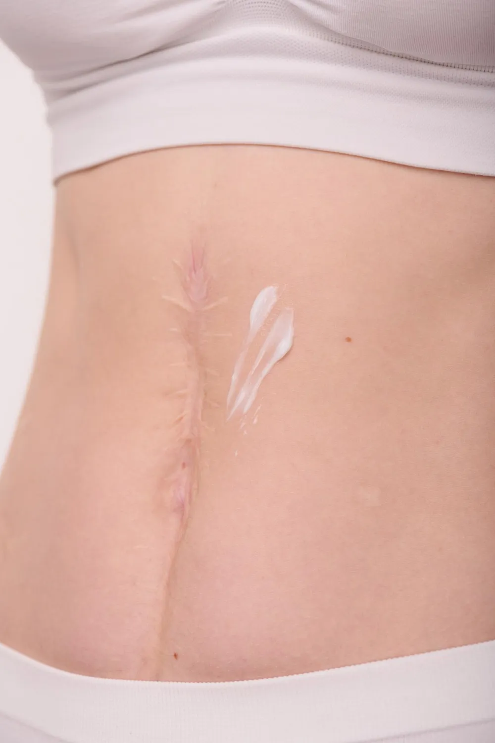 Scar Revision & Keloid Correction
