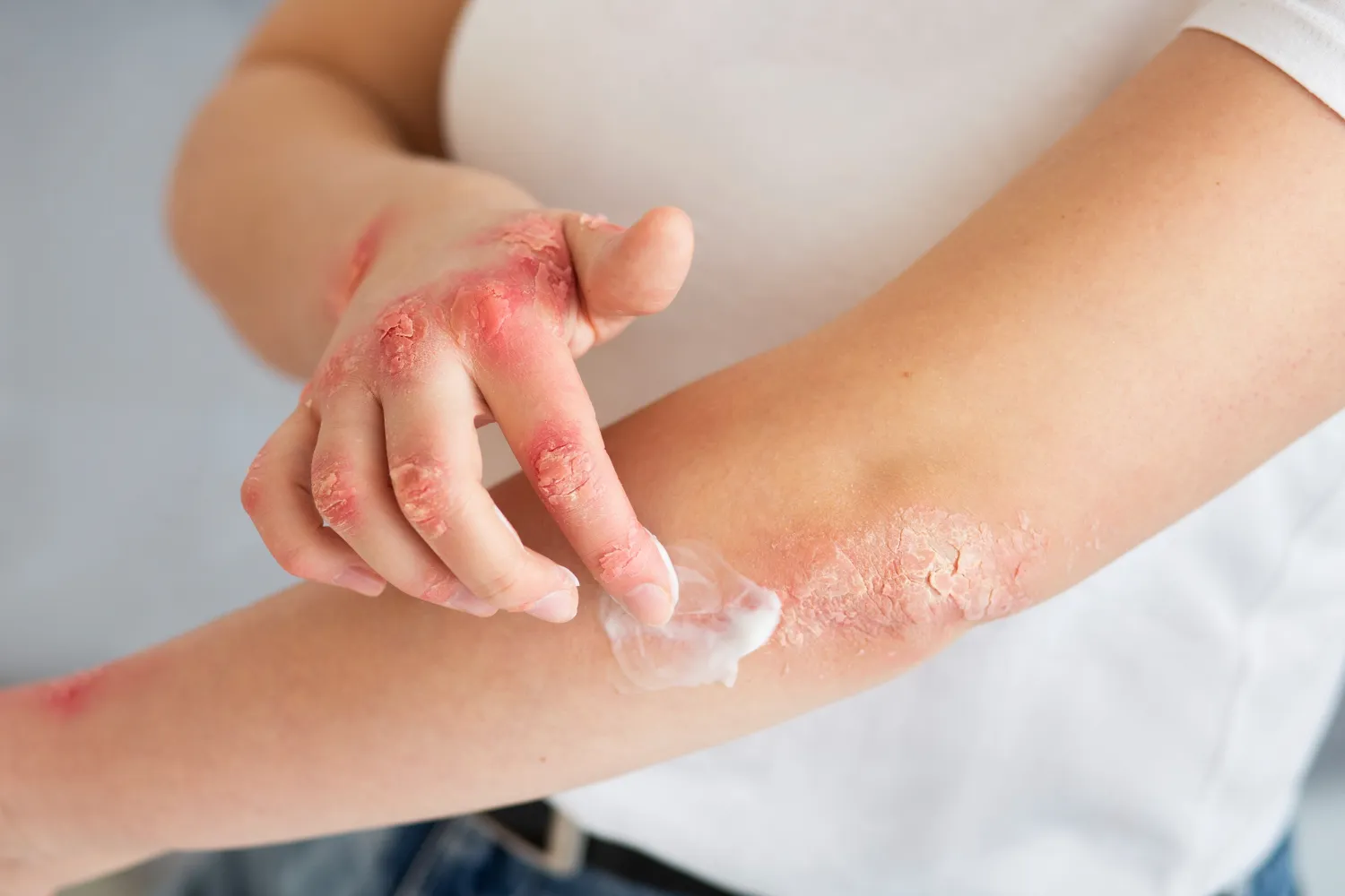 Eczema (Atopic Dermatitis)