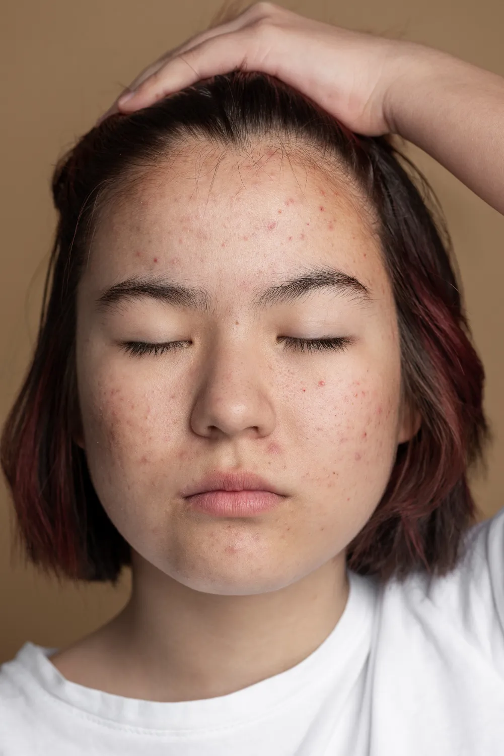 Melasma
