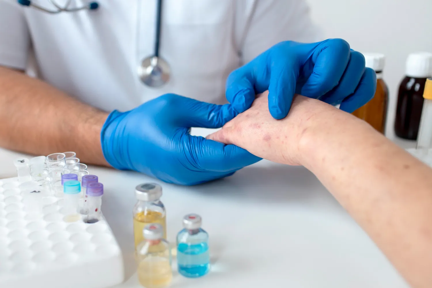 Psoriasis