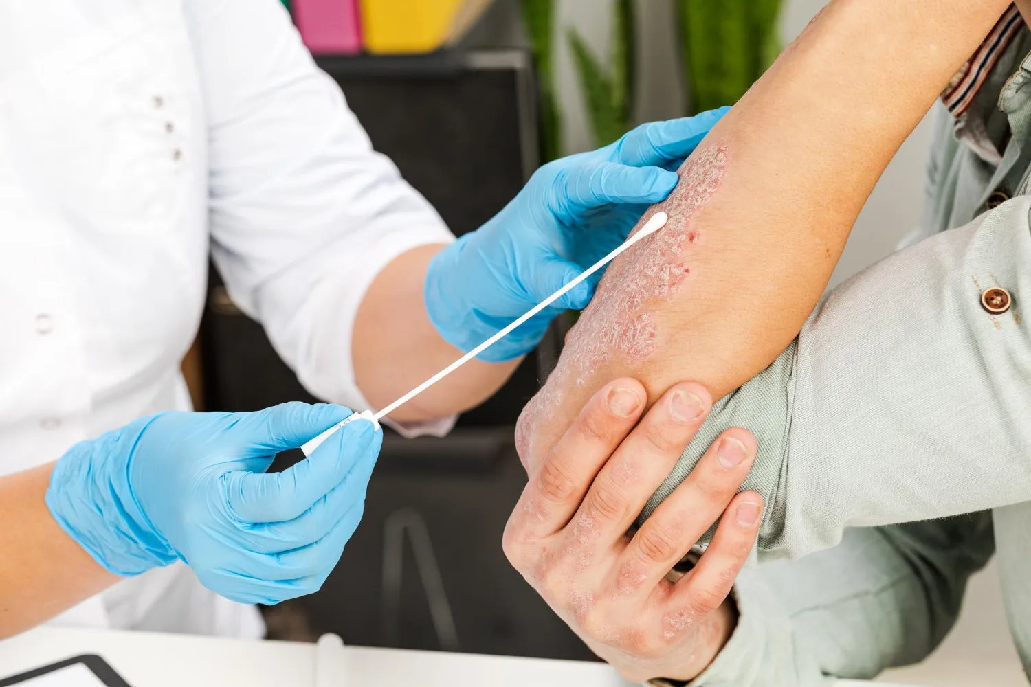 Skin Infections