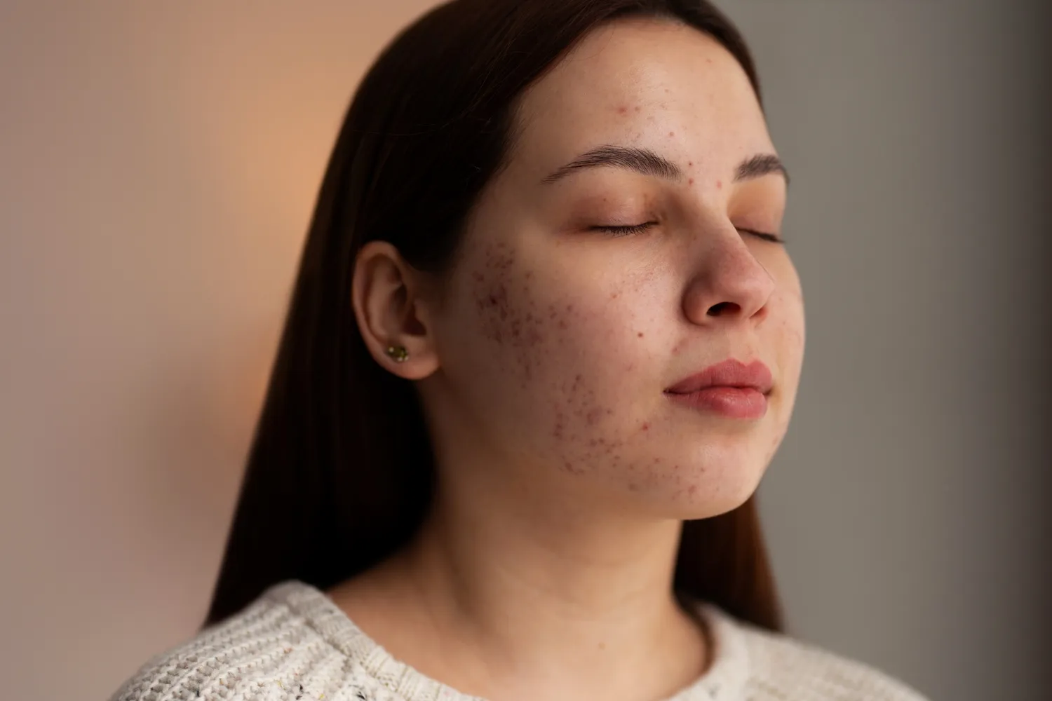Acne Management & Blackhead Extraction