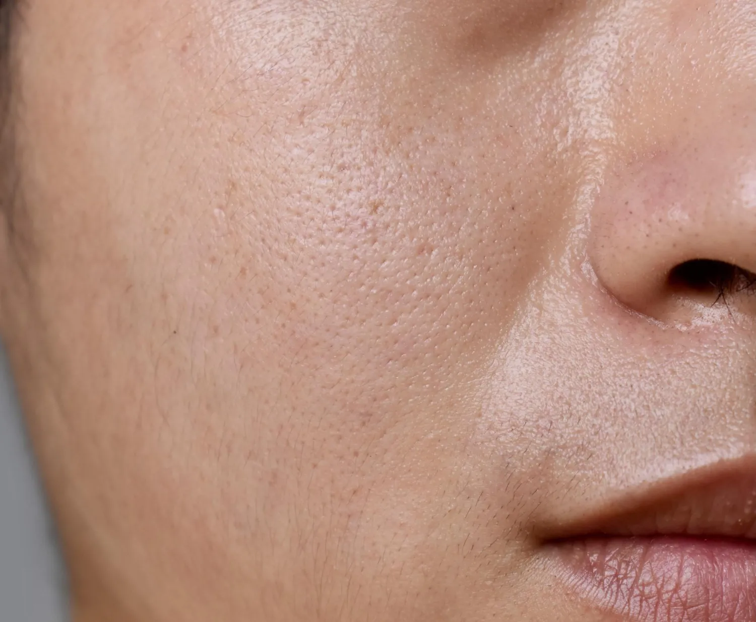 Open Pore & Texture Correction